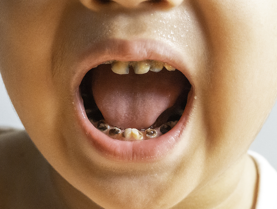 Cavities Are Ageless