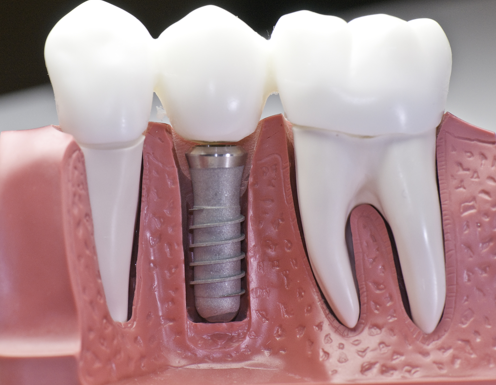 Post-Op Care Of Dental Implants Is Easy