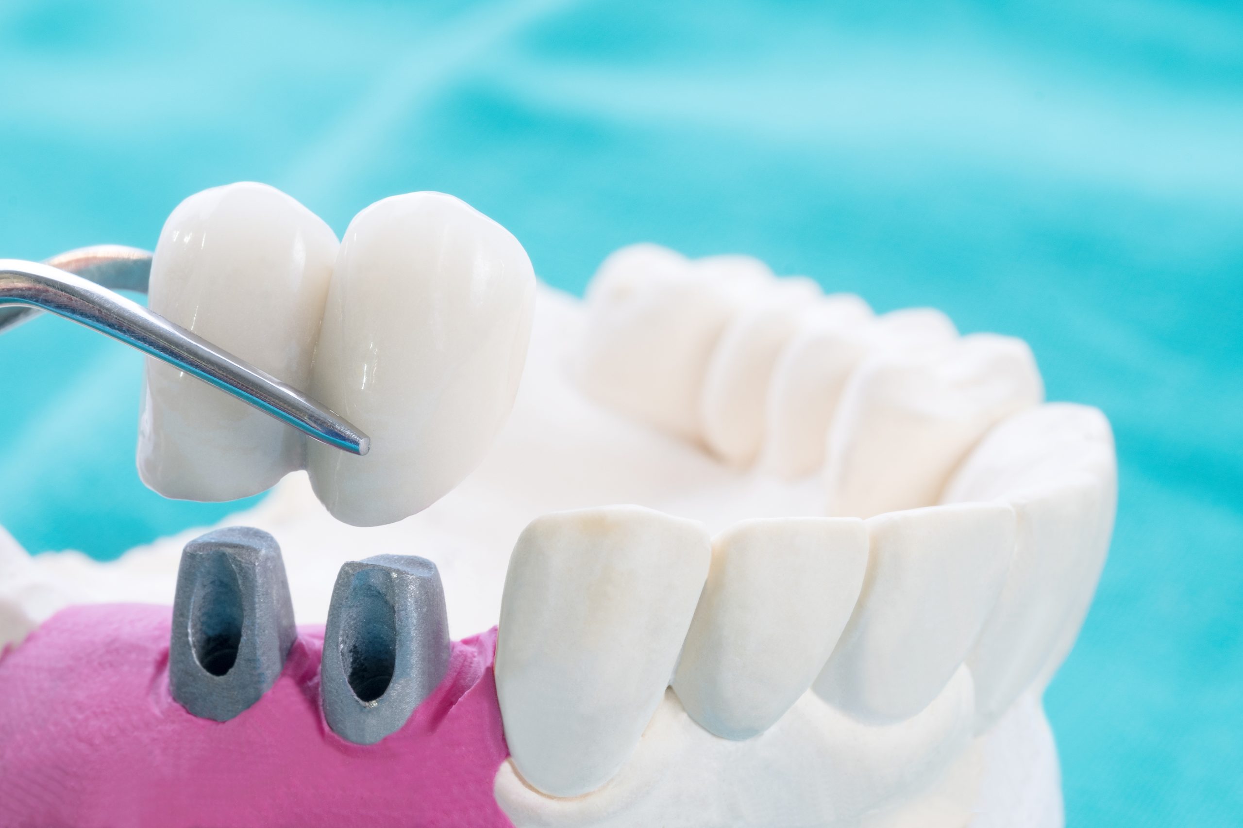 Full Denture Implants: What You Need to Know