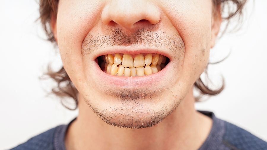 Store Bought Kits vs. Our Professional Teeth Whitening Service