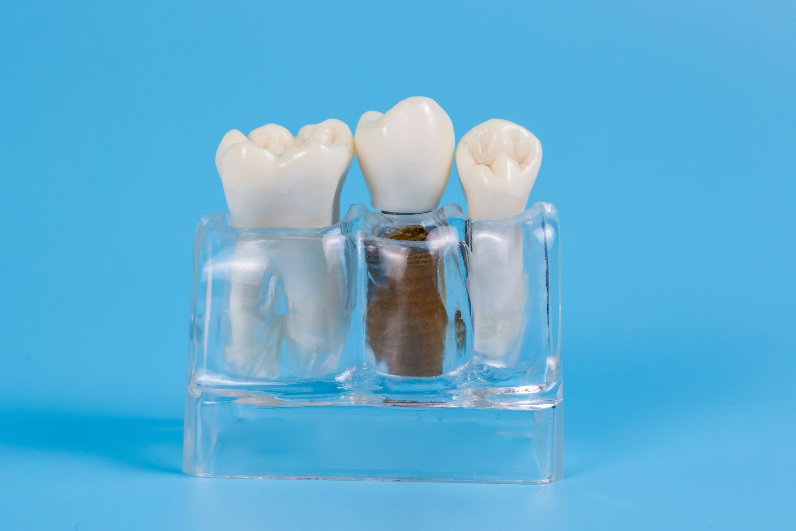 Implant-Supported Dentures Can Restore Your Smile