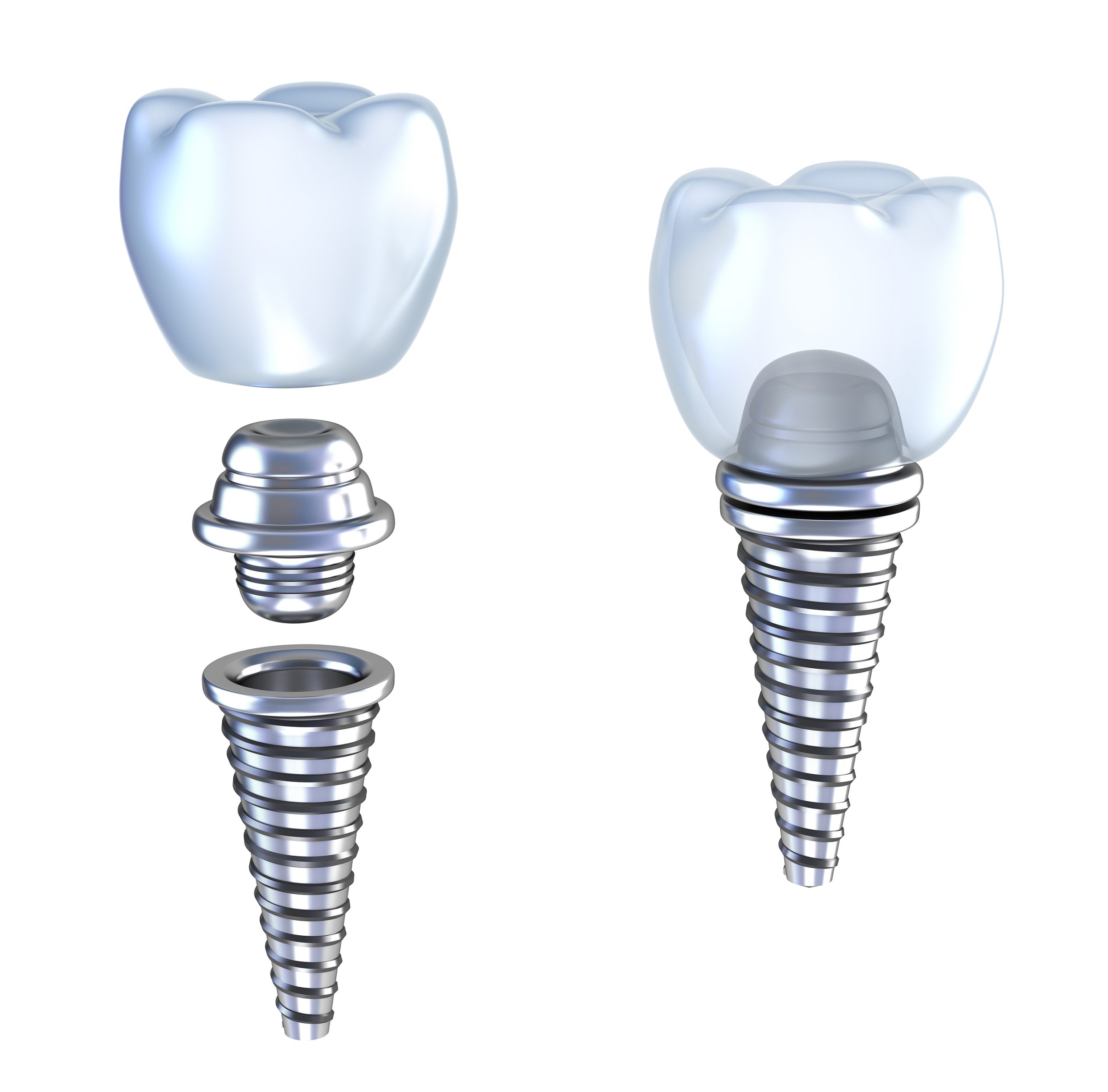 Walnut Creek Dental Implants