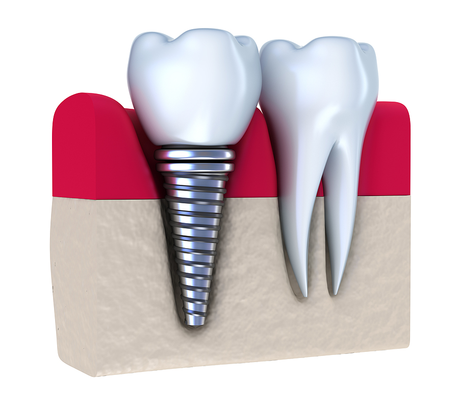 Dental Implants are The Solution For Missing Teeth