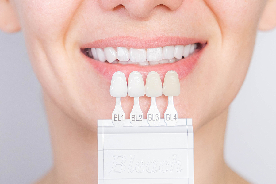 Porcelain Veneers – Is Your Mouth Ready?