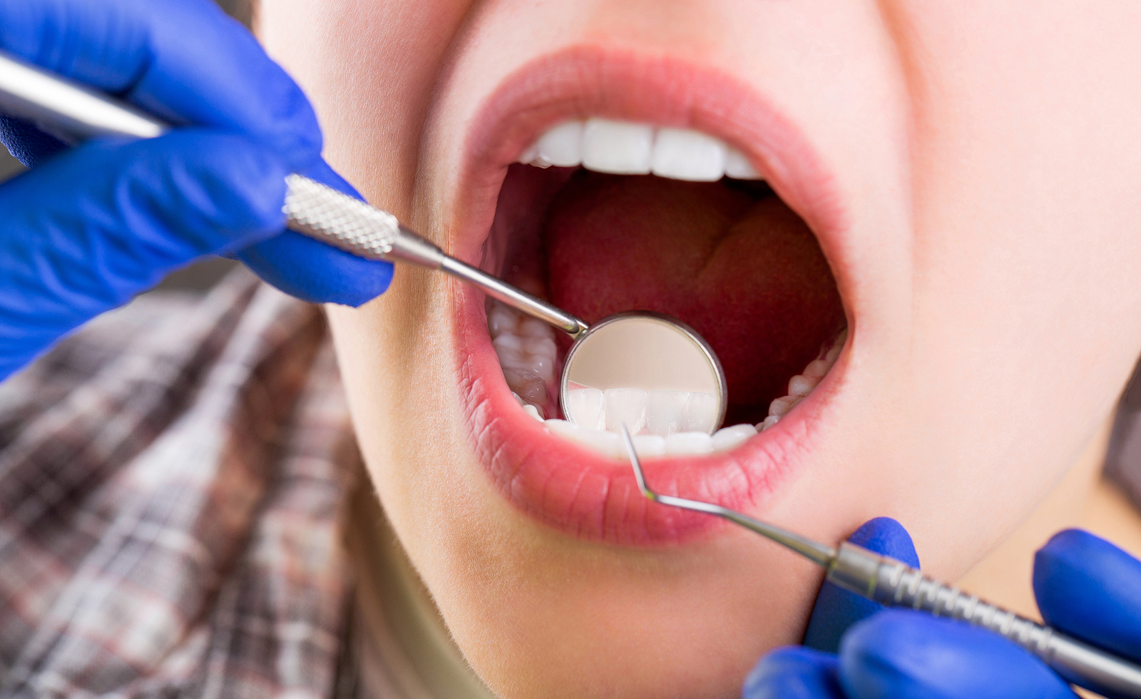 Dental Bonding: What You Should Know