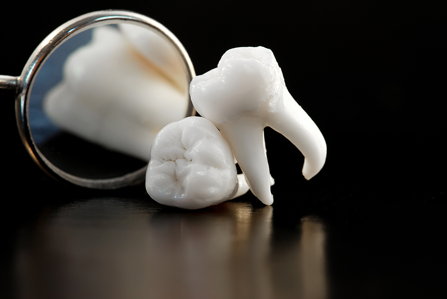 Wisdom Tooth Extraction: How It’s Done
