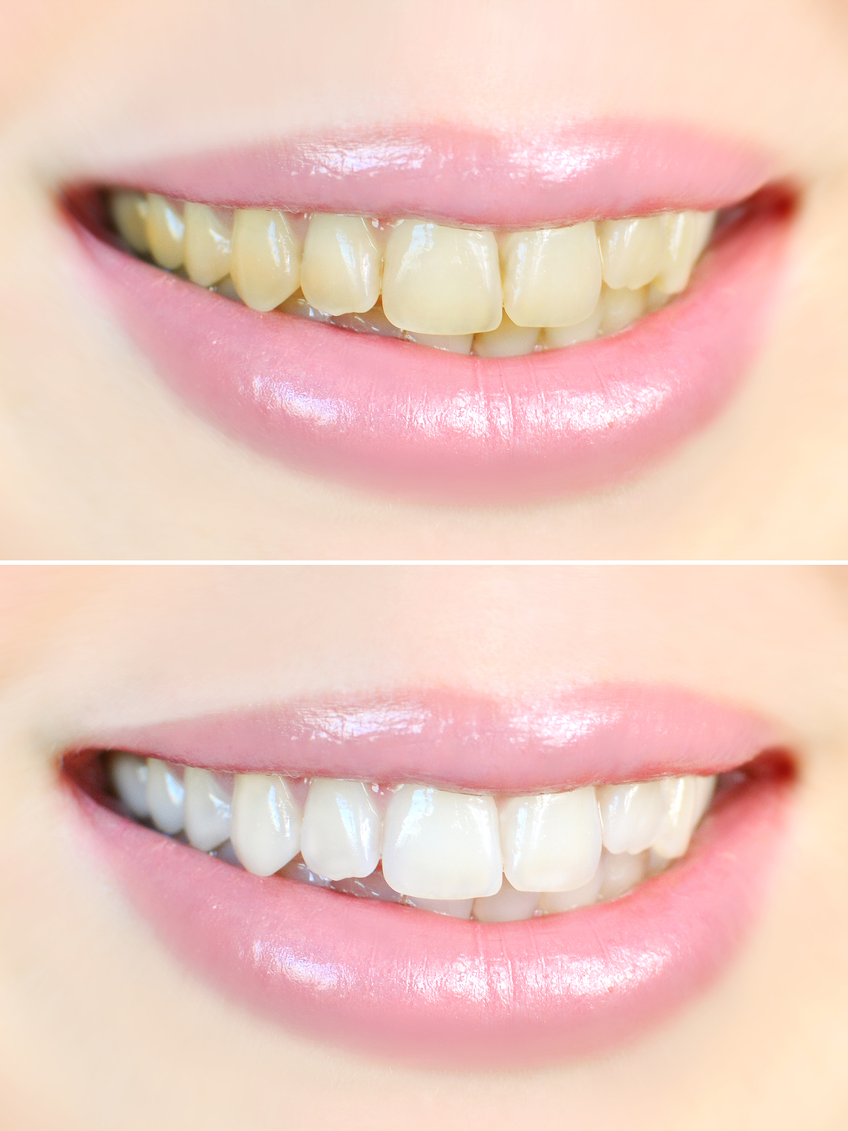 Brighter Teeth For a Brighter Smile