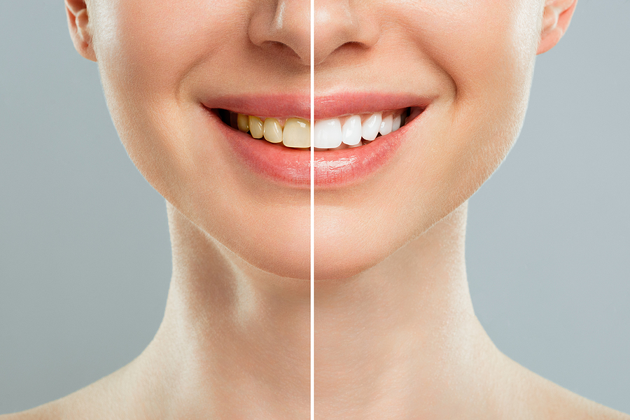 Brighten Up Life With A Smile Makeover