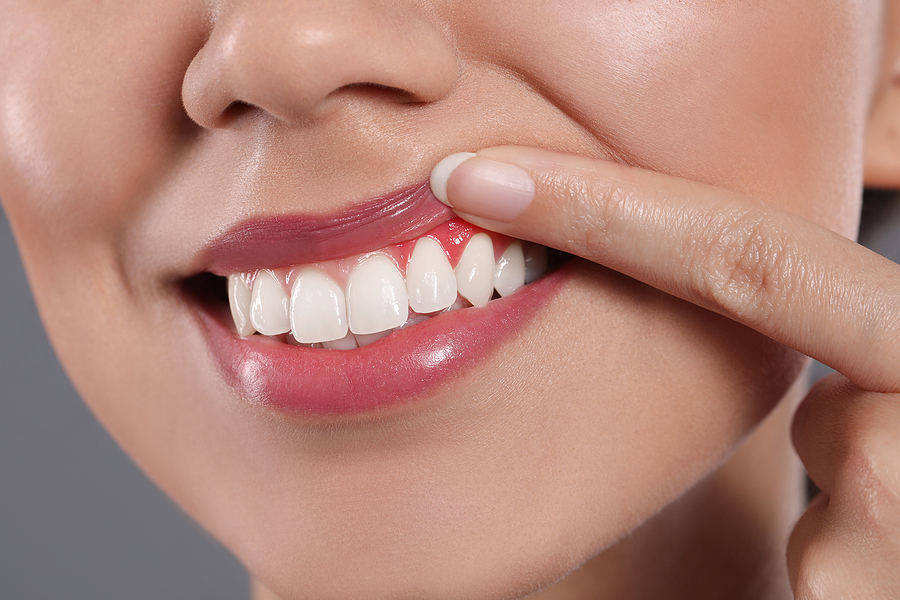 How Do I Treat Receding Gums?