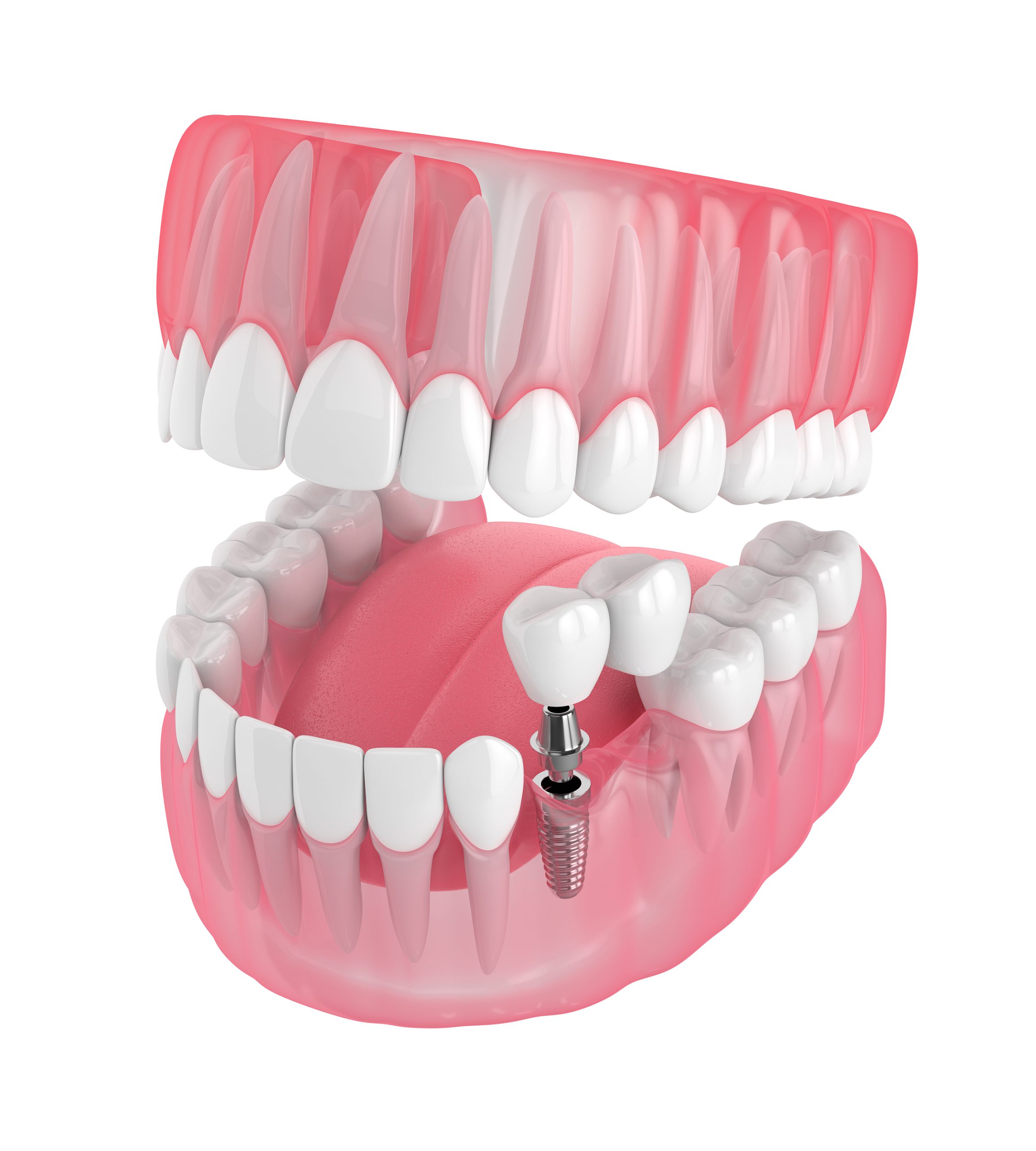 What are Implant-Supported Dentures?