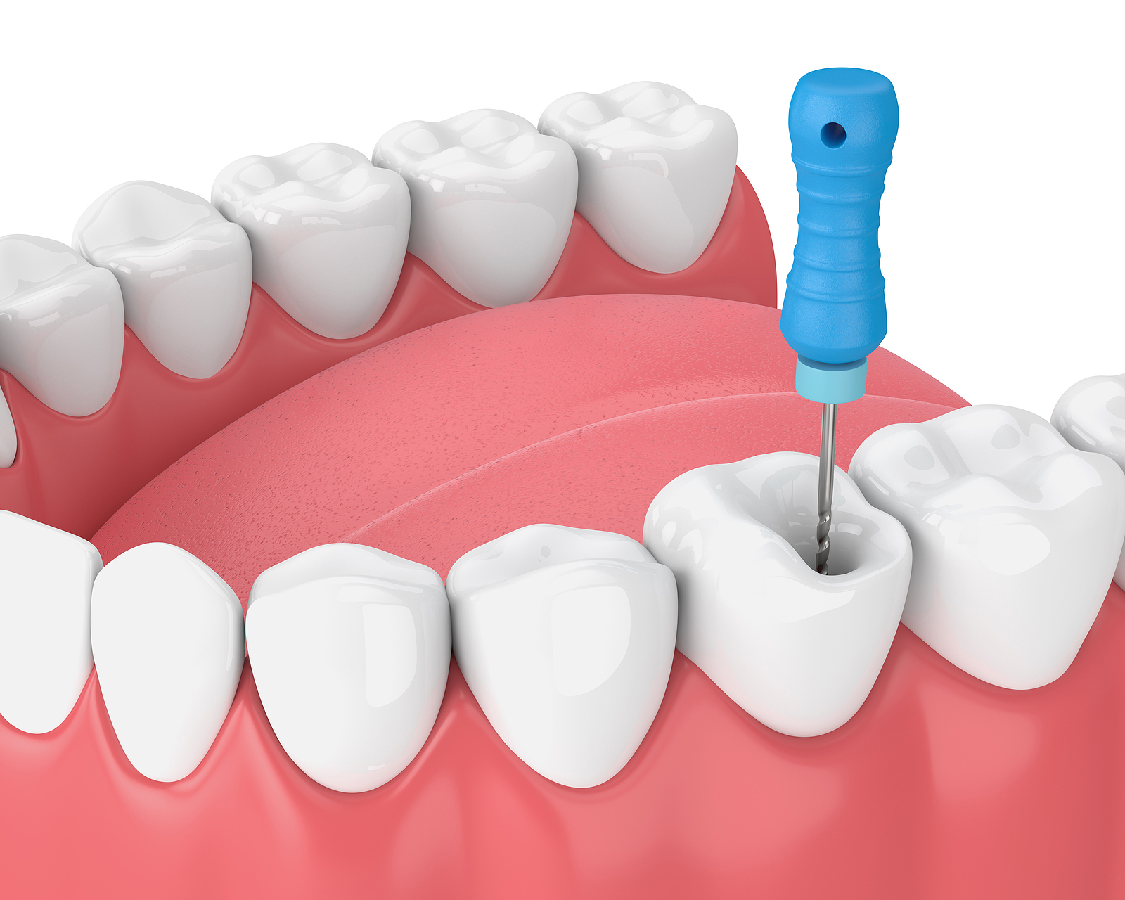 How Root Canal Therapy Can Save Your Tooth