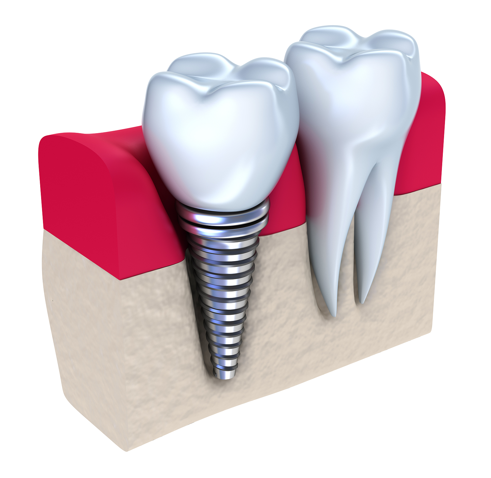 Am I a Candidate for Implant Restoration?