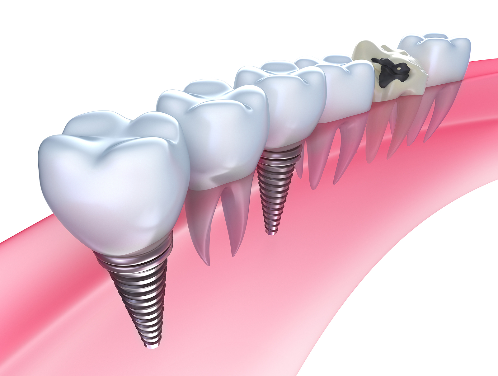 The Impact of Dental Implants on Your Facial Structure
